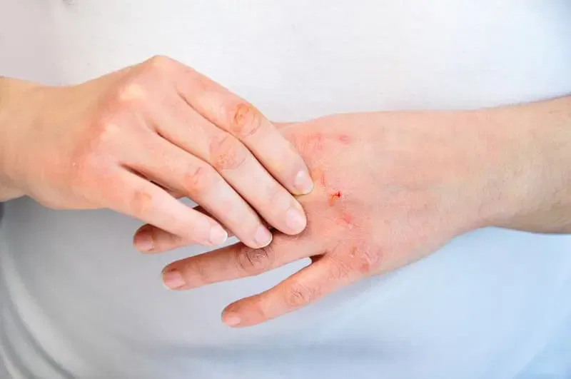 Skin problems caused by radiation and e-smog